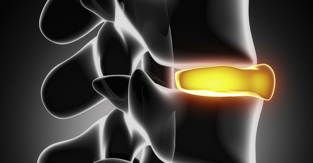 North St. Louis, MO non-surgical disc herniation treatment