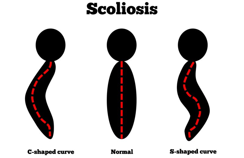 St. Louis, MO scoliosis treatment